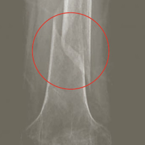 Osteoporosa Osteoporosa